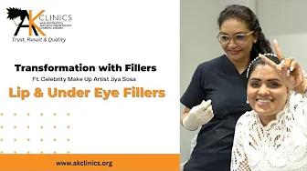 Lip Fillers Before and After | Under Eye Fillers for Dark Circles Treatment | AK Clinics